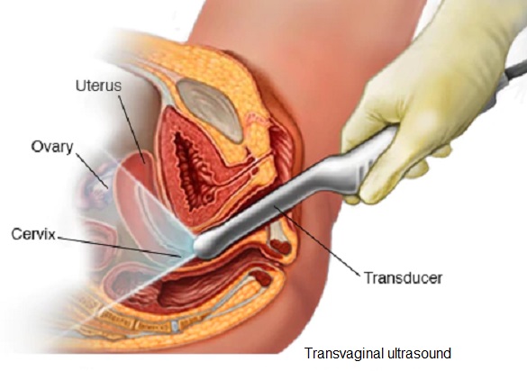 endometriosis Transvaginal ultrasound Treatment