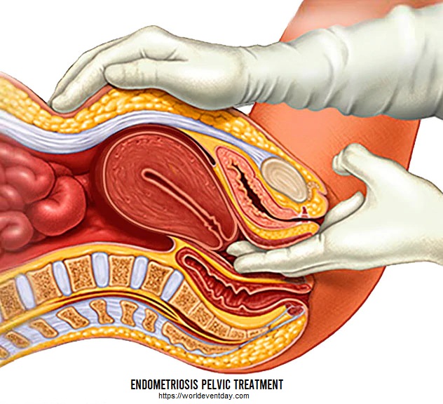 endometriosis pelvic Treatment