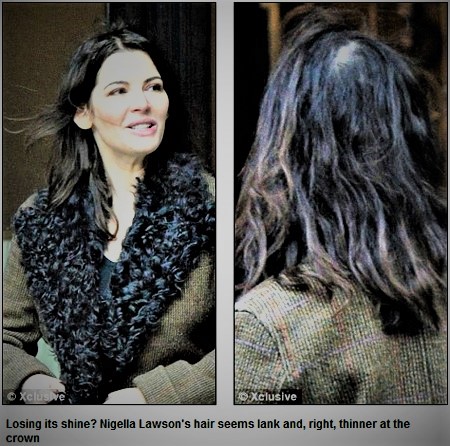 Nigella Lawson Dull and Thinning The Belgravia Centre for Hair Loss