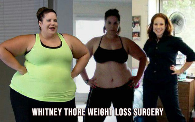 whitney thore weight loss surgery before and after